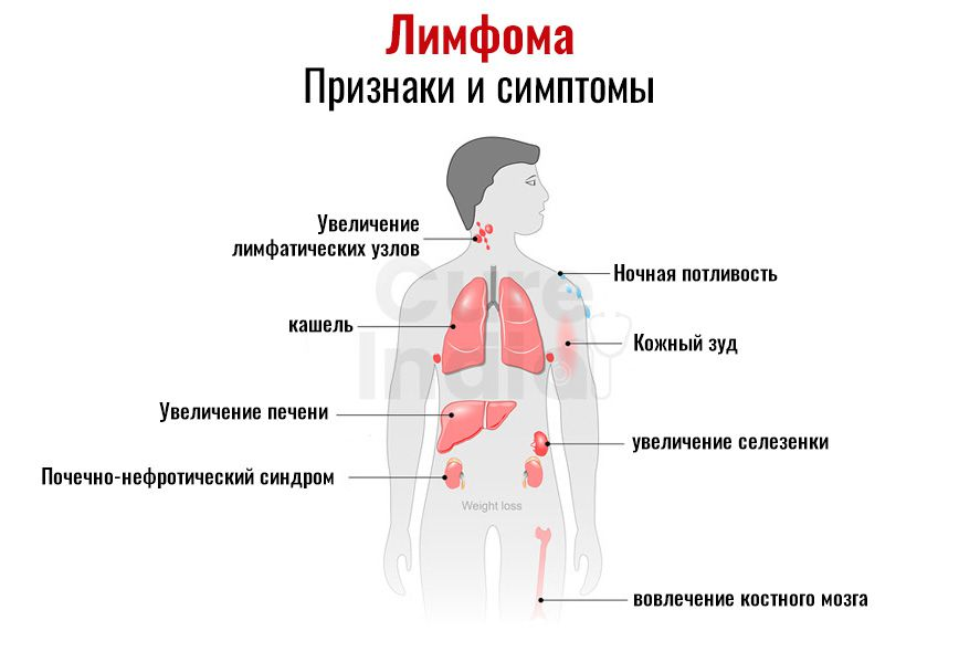 Увеличенные лимфоузлы температура 37. Лимфома Ходжкина симптомы симптомы. Лимфатический узел при лимфоме Ходжкина. Ходжкинская лимфома симптомы. В-симптомы при лимфоме Ходжкина.