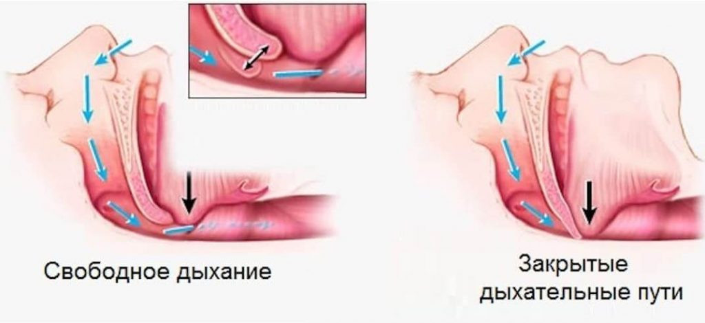 Причину возникновения апноэ при храпе можно устранить хирургическим путем, с помощью специальных кап или СИПАП-терапии